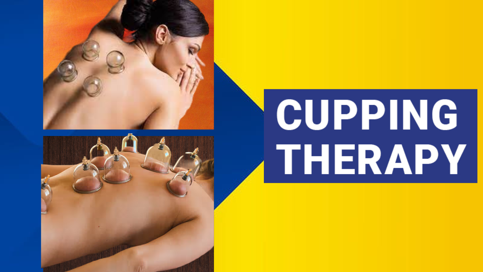 Cupping Therapy in Mumbai